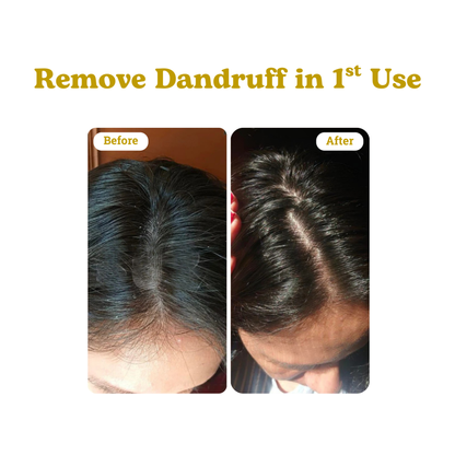 Anti Dandruff Hair Oil