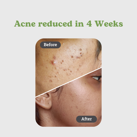 Anti Acne Face Pack