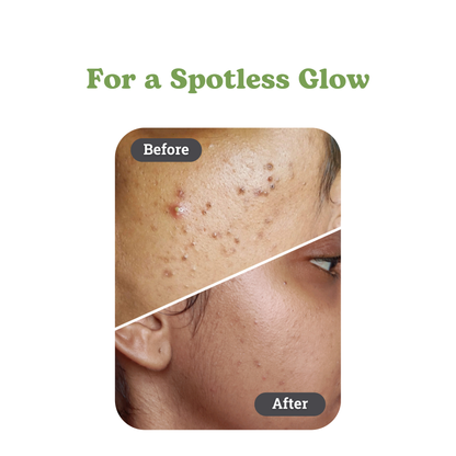 Anti Acne Combo